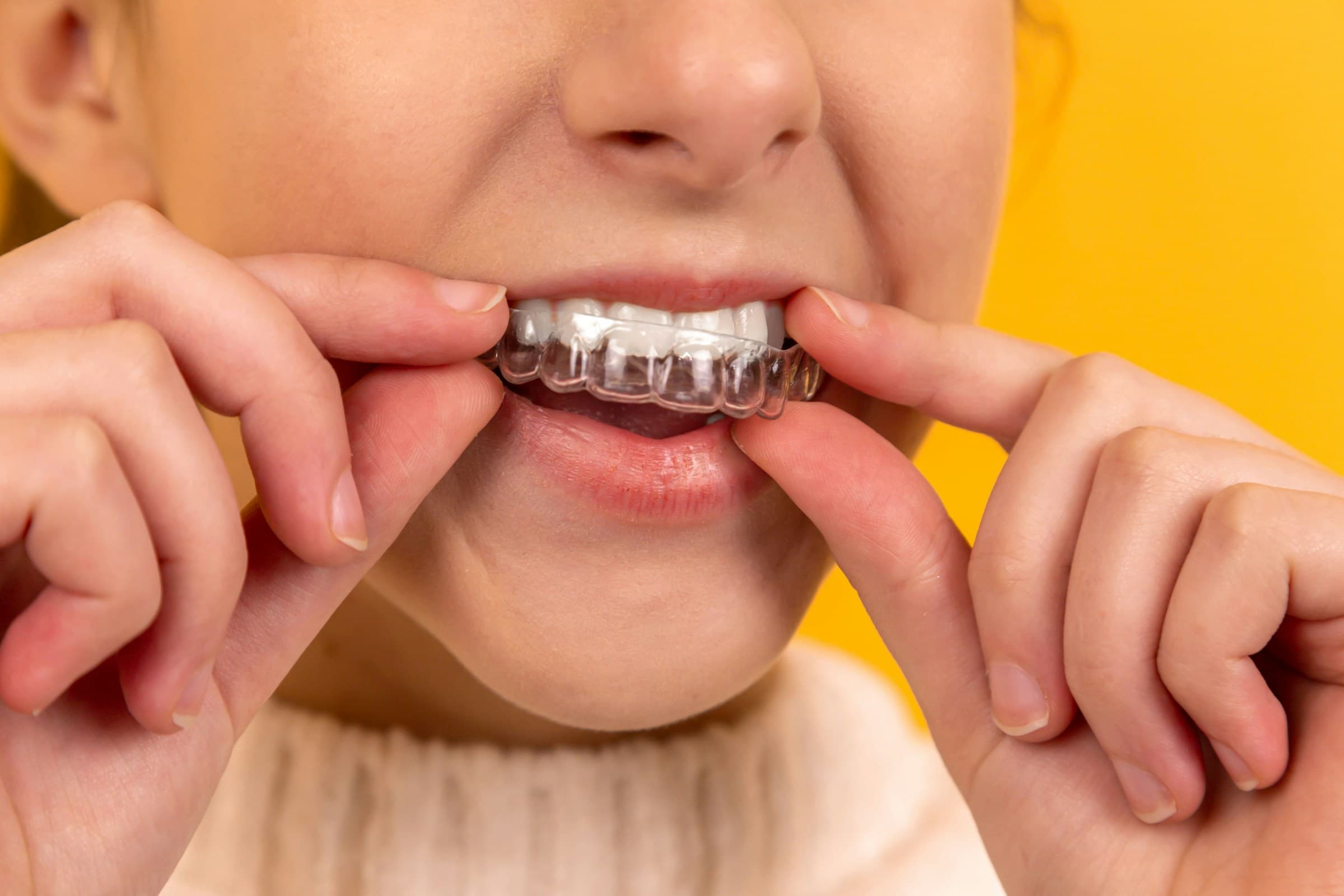 A close-up of a dental retainer being placed in the mouth, used in orthodontic treatment