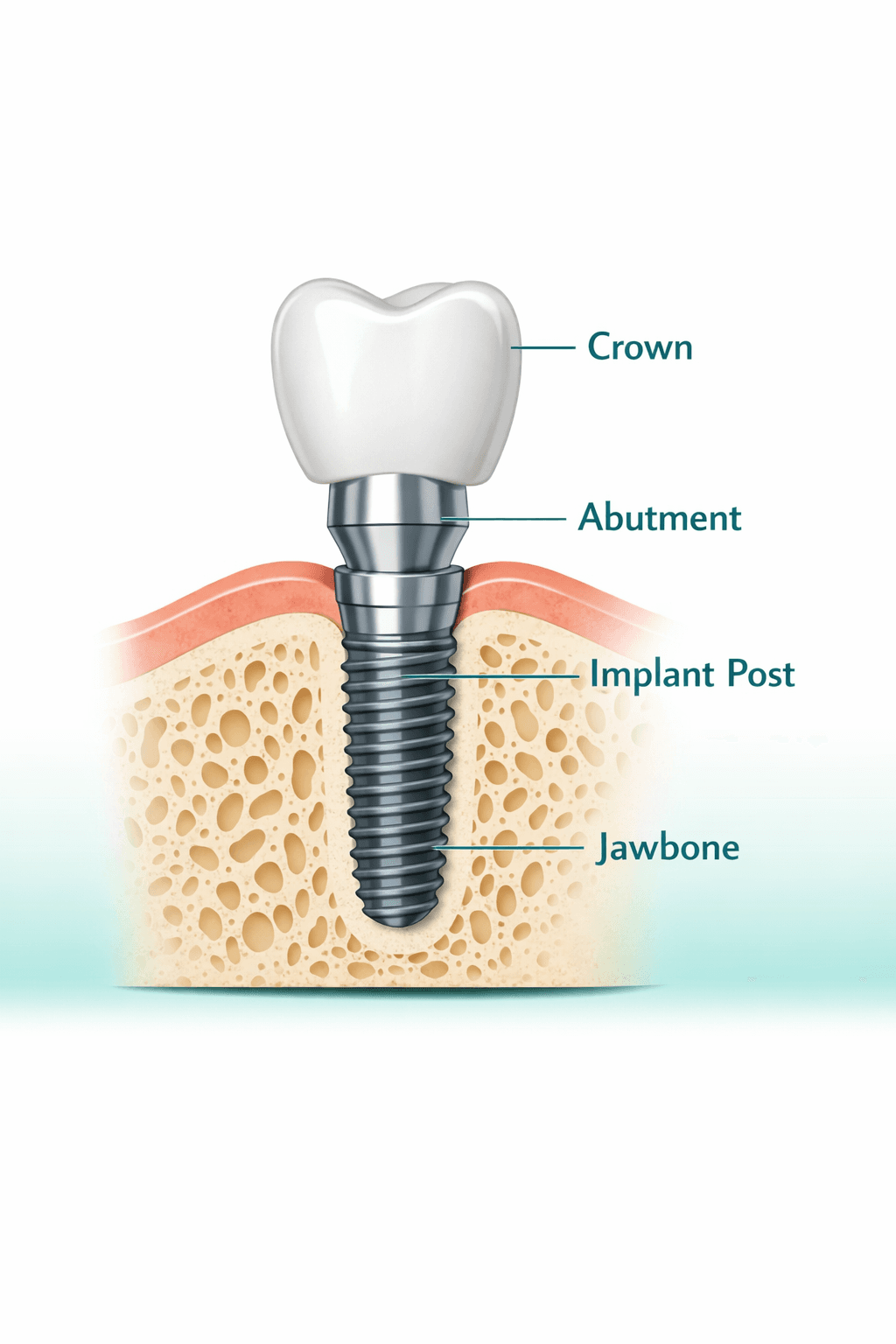 Dental implant diagram showing crown, abutment, implant post and jawbone
