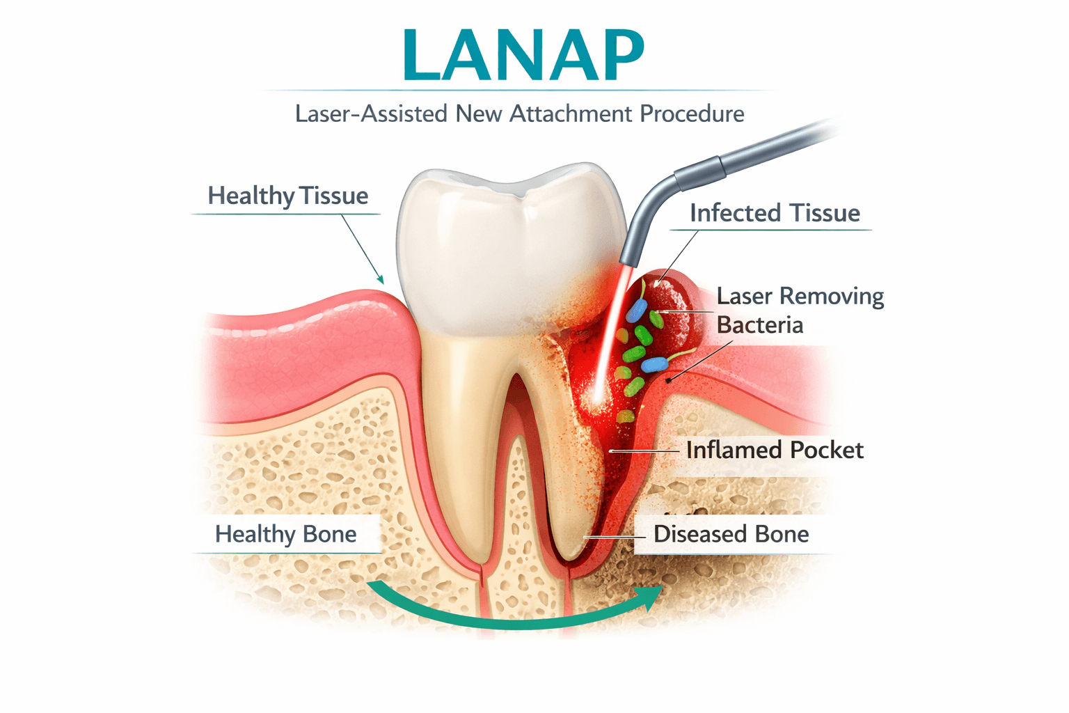 LANAP laser treatment process diagram showing how the laser targets bacteria while preserving healthy tissue
